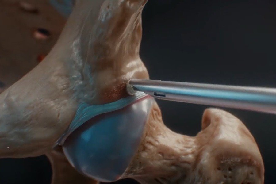 tsikouris hip femoroacetabular
